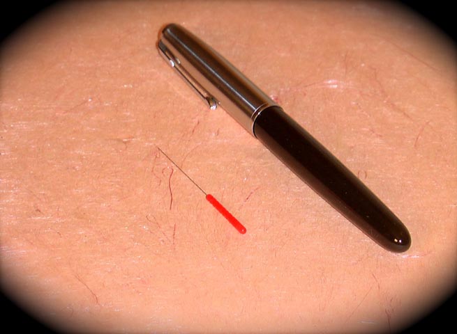 A 'Hair-thin' Acupuncture Needle